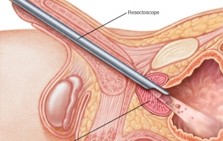 ransurethral Resection of The Prostate