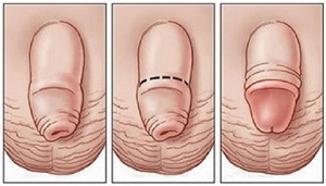 Phimosis