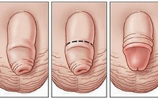 Phimosis