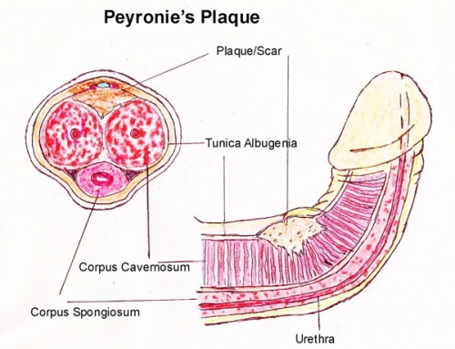 Symptoms and Causes of Peyronie’s Disease